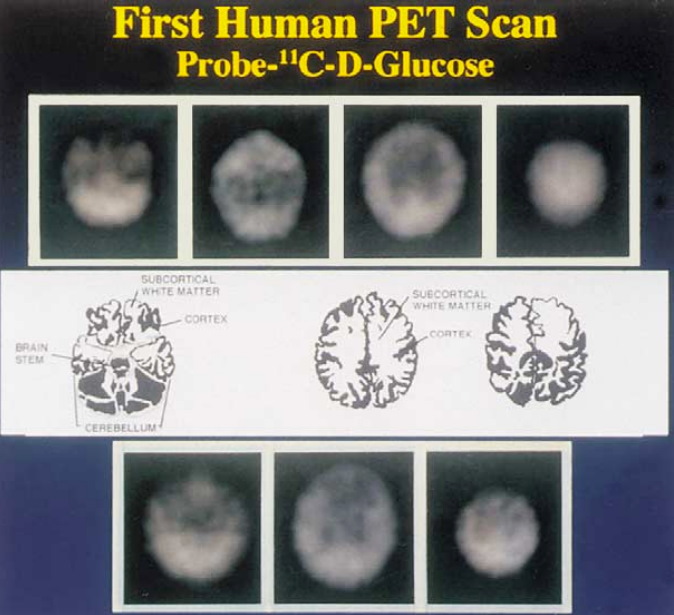 First human PET scan