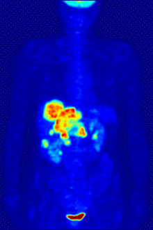 PET-Scan (gif)