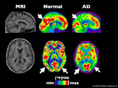 PET scan - healthy brain vs early Alzheimer